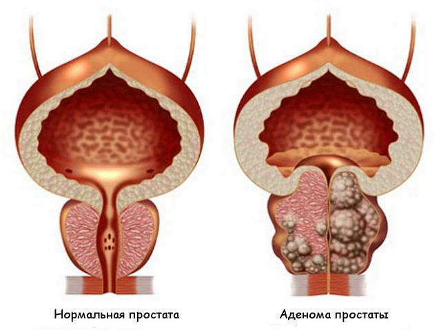 Средство от простатита и аденомы простаты Средство от простатита и аденомы простаты