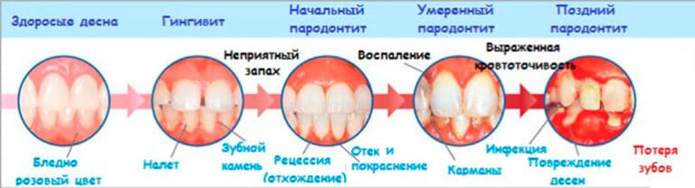 Что делать если у меня отслаиваются десна Что делать если у меня отслаиваются десна