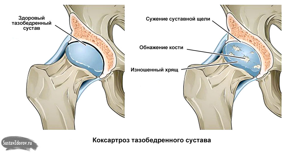 Боли в тазобедренном и коленном суставе причины Боли в тазобедренном и коленном суставе причины