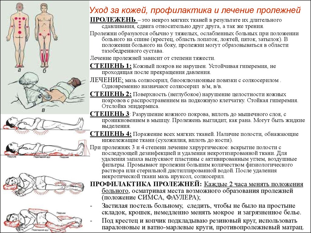 Обучение родственников уходу за пролежнями Обучение родственников уходу за пролежнями