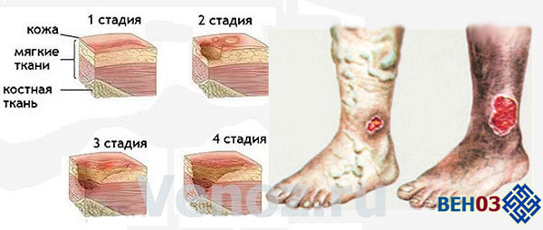 Как появляется язва на коже Как появляется язва на коже