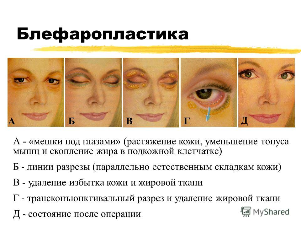 Как убрать отек над глазами в домашних условиях Как убрать отек над глазами в домашних условиях
