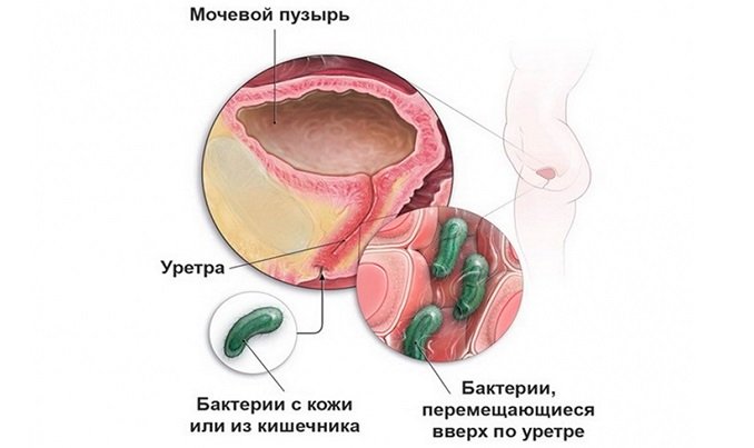 Фитолизин при цистите отзывы врачей и пациентов