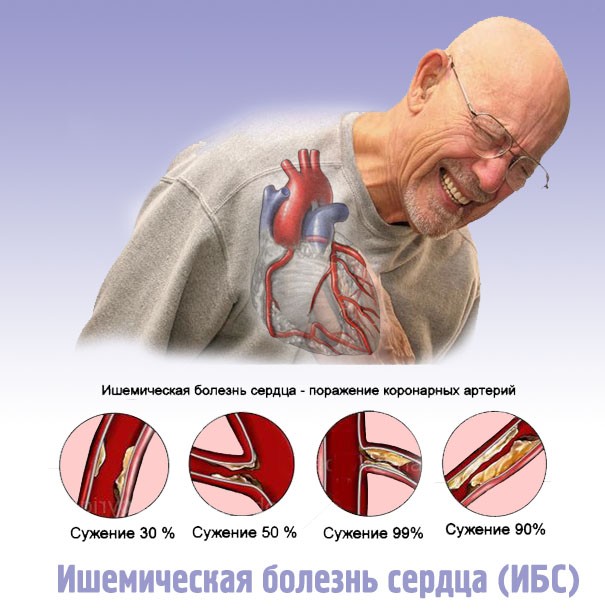Что делать если есть ишемия сердца