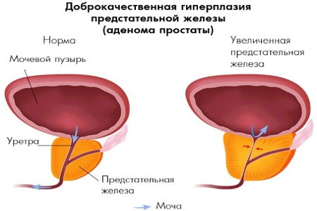 Чем уменьшить размер простаты Чем уменьшить размер простаты