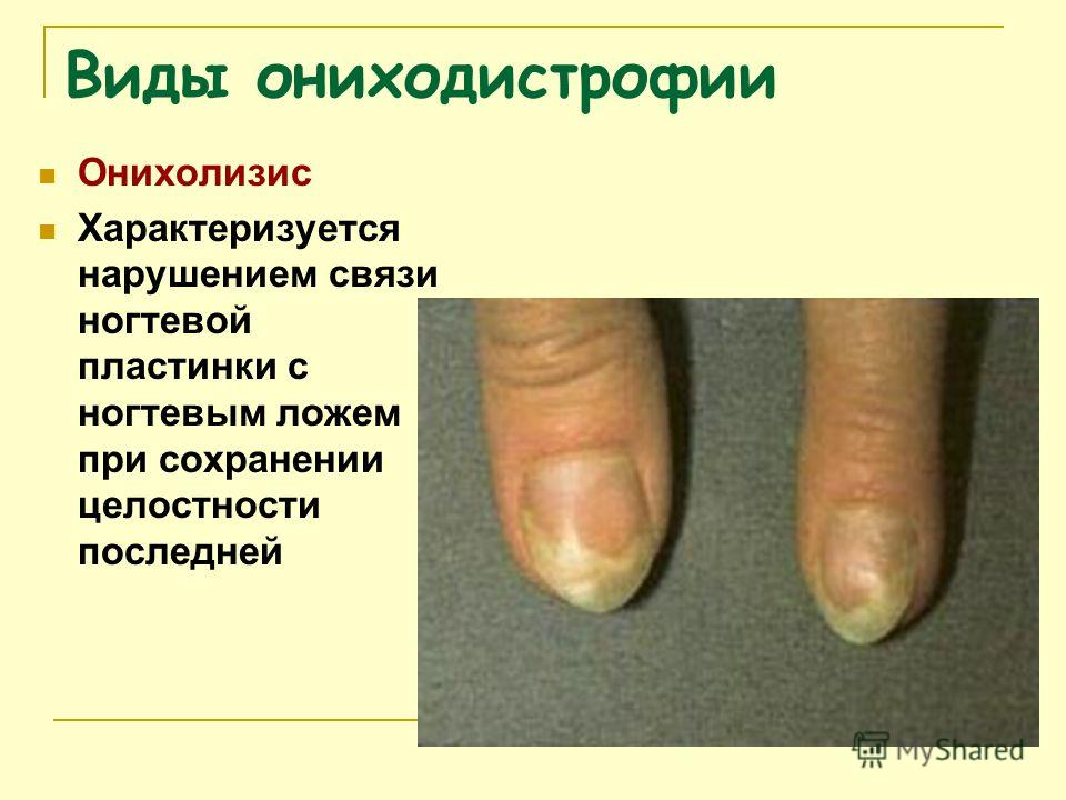 Чем лечат онихолизис ногтей Чем лечат онихолизис ногтей