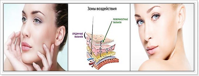 Как делать хим пилинг Как делать хим пилинг