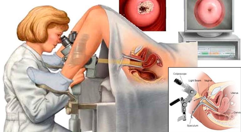 Что такое биопсия матки в гинекологии