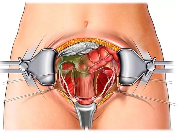Опухоли женских органов гинекология