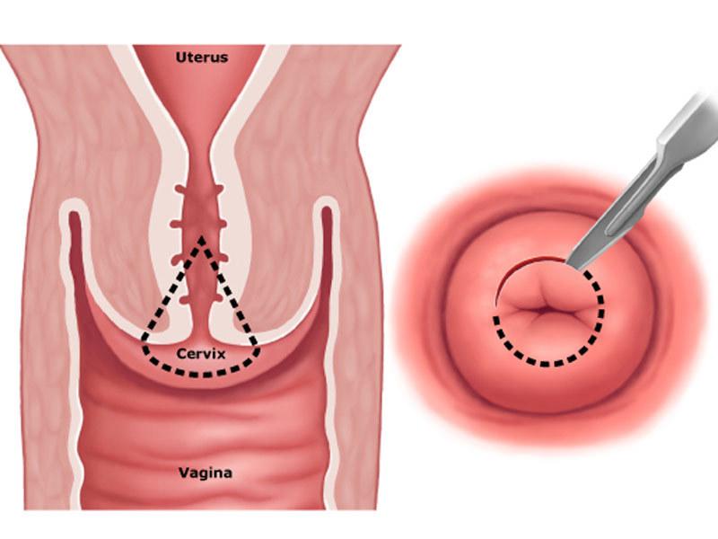 Рак шейки матки гинекология