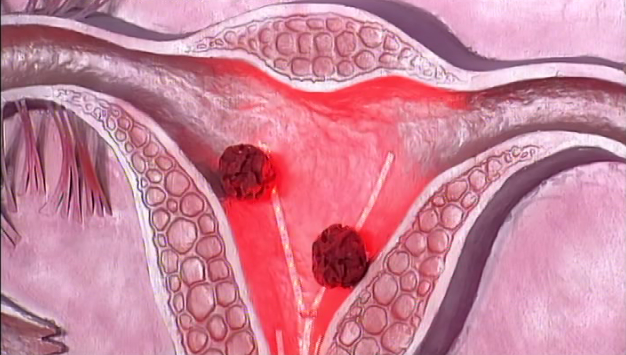 Вобэнзим в гинекологии при кисте яичника